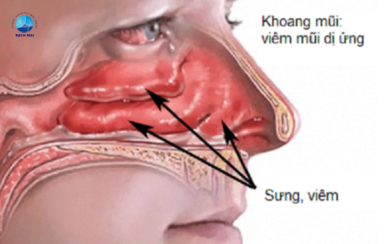 các bệnh lý về mũi