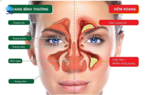 các bệnh lý về mũi