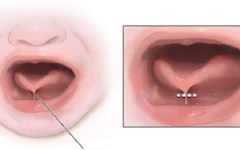 dính lưỡi thắng ở trẻ em