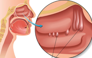 polyp mũi có nguy hiểm không