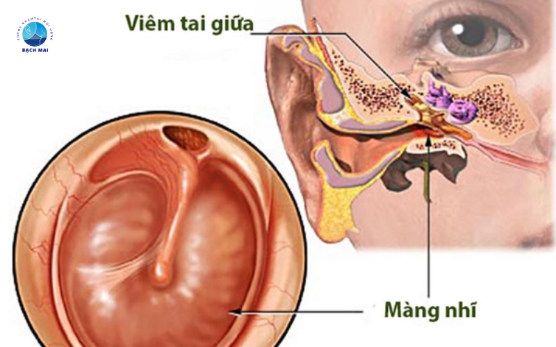 Sau khi mổ viêm tai giữa nên kiêng gì