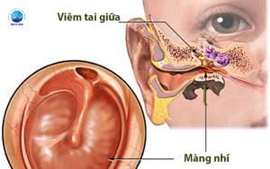triệu chứng viêm tai