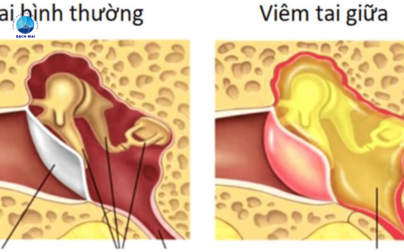 triệu chứng viêm tai