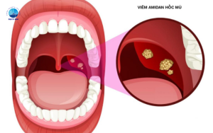 viêm amidan hốc mủ