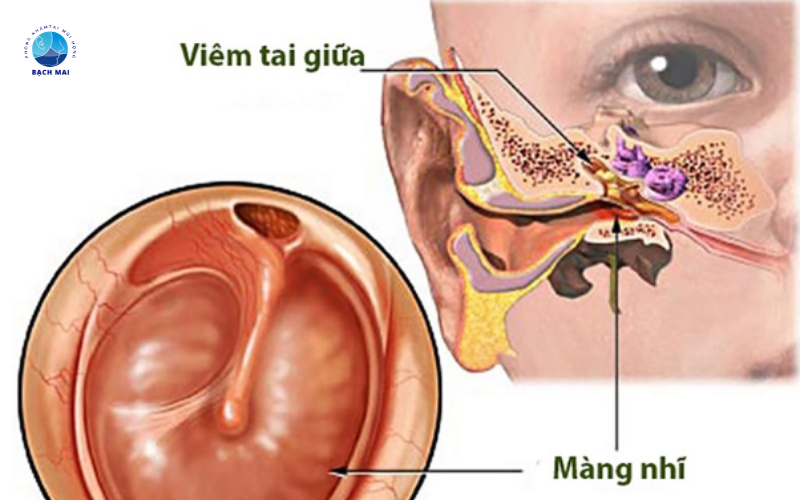 viêm tai xương chũm