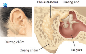 viêm tai xương chũm