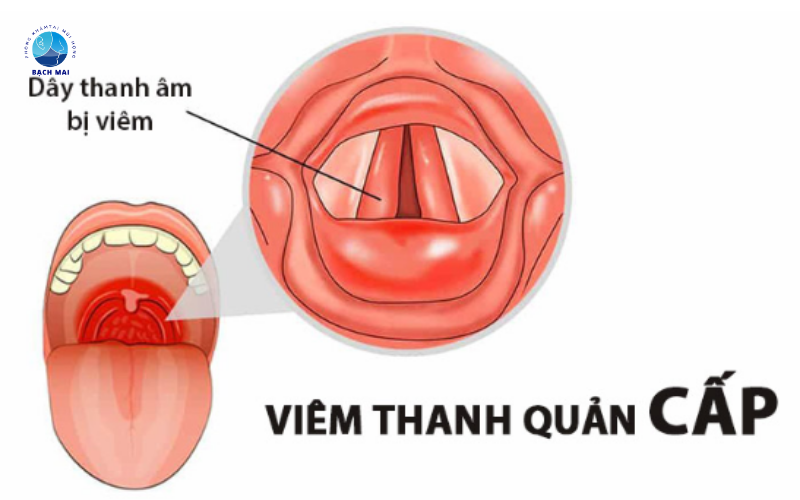  viêm thanh quản 