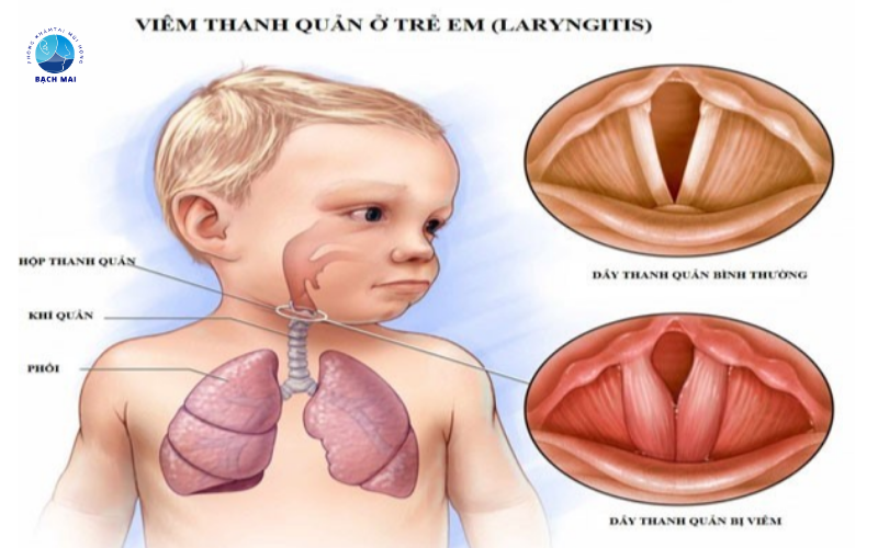 viêm thanh quản cấp ở trẻ em