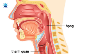 viêm thanh quản cấp tính