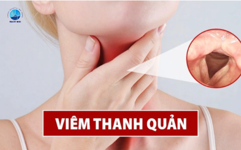  viêm thanh quản 