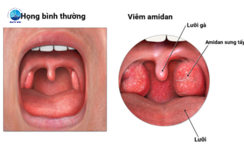 Bệnh viêm tai mũi họng 