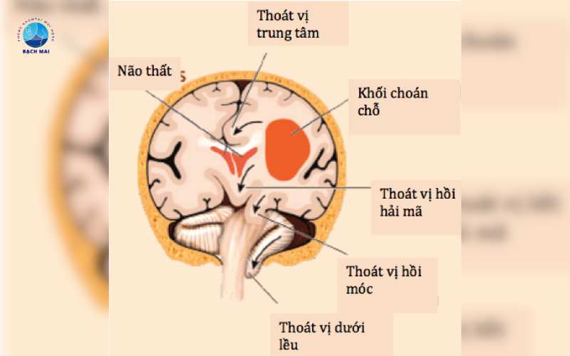 Biến chứng của viêm xoang