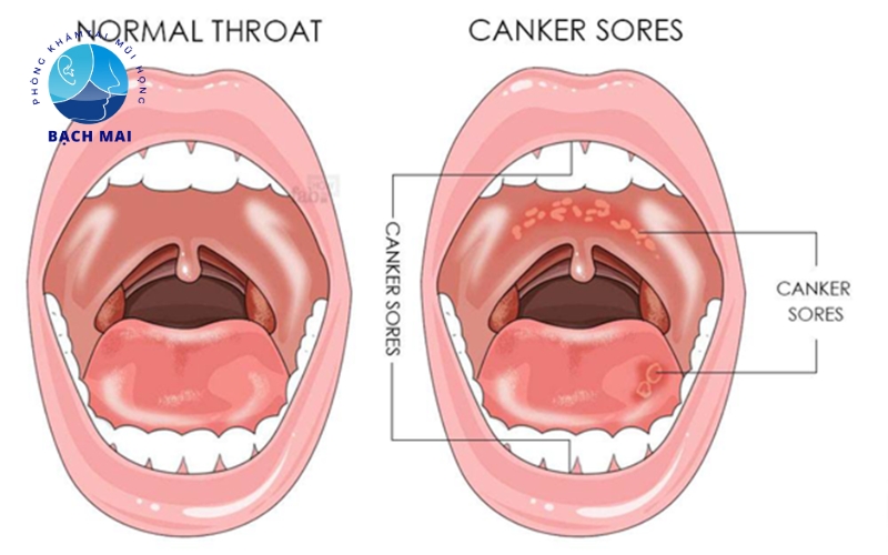 Nguyên nhân nhiệt miệng