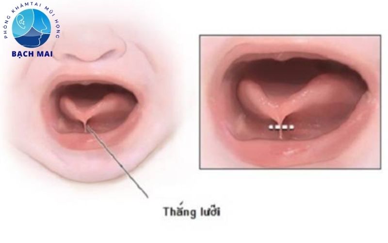 Thời điểm cắt thắng lưỡi cho trẻ lúc nào phù hợp nhất?
