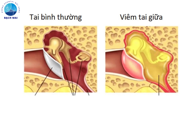 dau hieu viem tai giua o tre so sinh 1