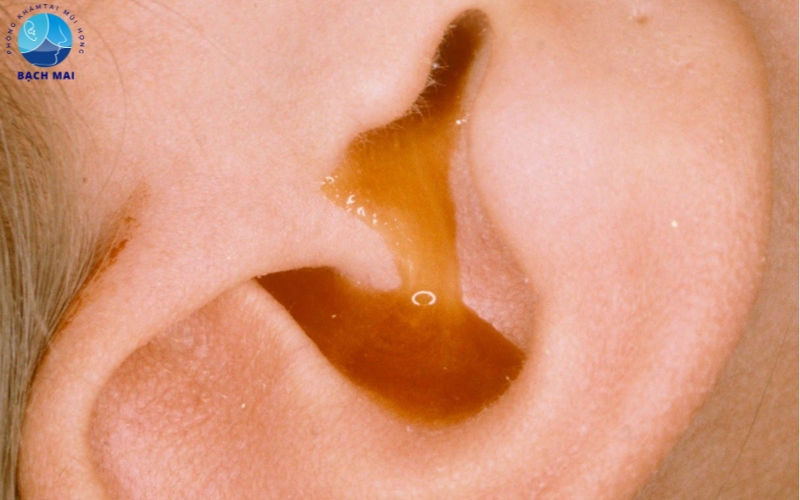 dau hieu viem tai giua o tre so sinh 3 1