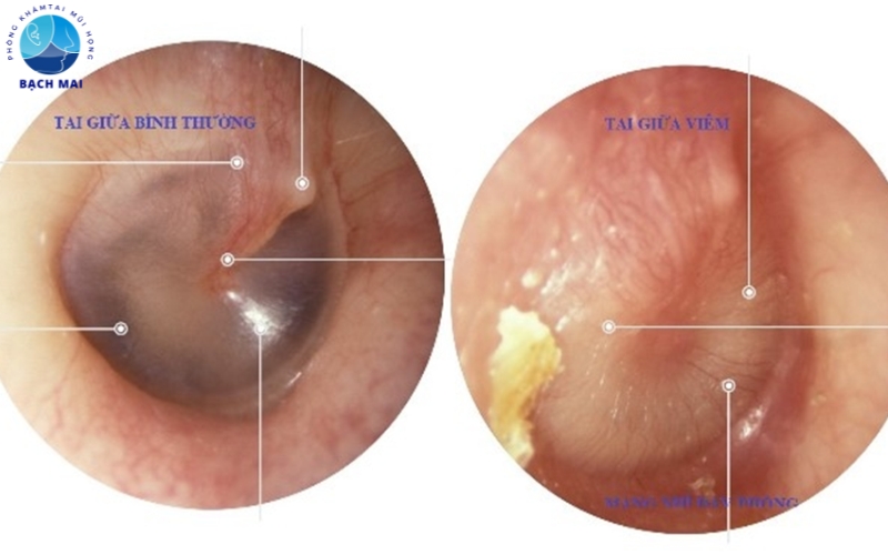 Đau nhói trong tai trái là dấu hiệu của bệnh gì?